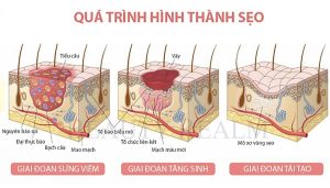 Bị sẹo kiêng ăn gì? - 5 mẹo trị sẹo lồi tại nhà hiệu quả