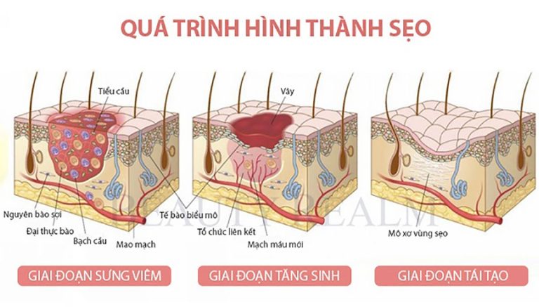 Bị sẹo kiêng ăn gì? - 5 mẹo trị sẹo lồi tại nhà hiệu quả